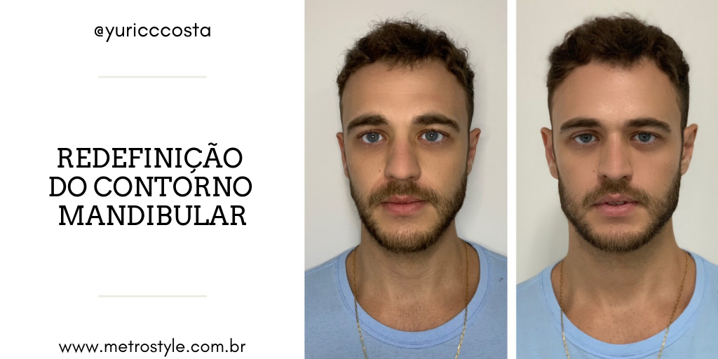 Harmonização Facial