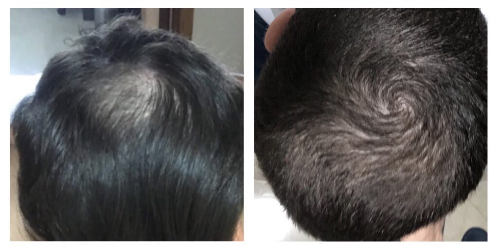 Facetune 09 07 2018 03 22 06 1024x518 - Sansez Hair: Fim da queda capilar e crescimento de novos fios.