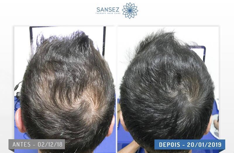IMG 0371 - Sansez Hair: Fim da queda capilar e crescimento de novos fios.